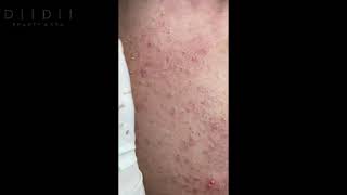 squeezing blackheads collection 3 [upl. by Hibbs]