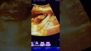 Cystic hygroma with a pregnancy about 17 week ultrasound video baby pregnant [upl. by Imar]