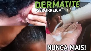 CURA de DERMATITE com COSMÉTICOS NATURAIS CREME de pentear SHAMPOO e CONDICIONADOR FEITO em CASA [upl. by Novihc]