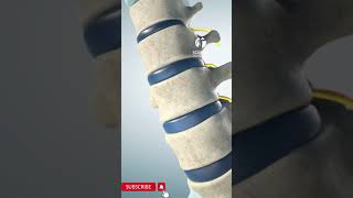 Spinal stenosis [upl. by Huntington422]