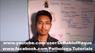 Infective Endocarditis Part 2 HD [upl. by Assili]