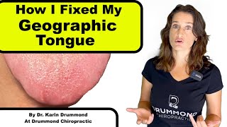 Geographic Tongue  Natural Remedies That Work [upl. by Nilknarf]