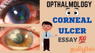 Ophthalmology Corneal ulcer  Bacterial keratitis Hypopyon corneal ulcerTamil [upl. by Zap]