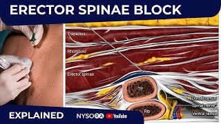 Erector Spinae Plane Block  Regional anesthesia Crash course with Dr Hadzic [upl. by Aenehs769]