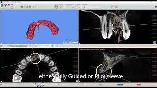 Unlock SMOP Mastery Essential Guide for Dentists  Hira Dental Lab Tutorial September 2024 [upl. by Bergeron58]