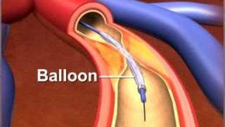 Percutaneous coronary Intervention stenting [upl. by Monagan]