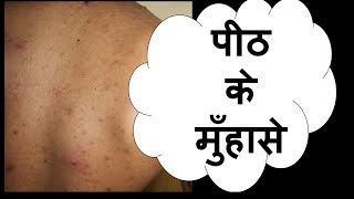 पीठ के मुँहासे  back acne  truncal acne hindi  डॉ आँचल पन्त [upl. by Charlene]