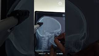 Cephalometrics tracing demonstration I DrHassan Rasheed [upl. by Kira316]