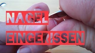 Fingernagel eingerissen [upl. by Jahncke396]