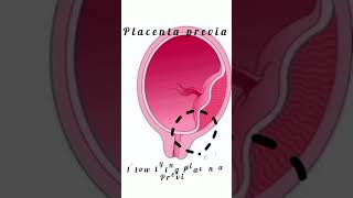 Placenta previa and its types kattrucate placentaprevia lowlyingplacenta postpartumhaemorrhage [upl. by Imoan]