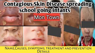 Contagious Skin Disease spreading in Mon Sadar what is this diseaseSymptomstreatment prevention [upl. by Edra655]