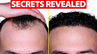 How to Fix Your Receding Hairline [upl. by Bevers]