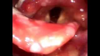 Гортанная ангина дифтерия гортани laryngeal diphtheria glottal angina [upl. by Irved82]