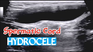 Ultrasound  Spermatic cord Hydrocele [upl. by Luehrmann]