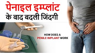 Penile implant surgery  Penile implant Surgery size and how they work  Aarogyam hospital durg [upl. by Yeltneb]