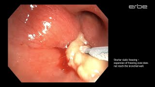 Cryoextraction of large mucous plug using ERBECRYO® 2 with 11mm cryroprobe [upl. by Yemac138]