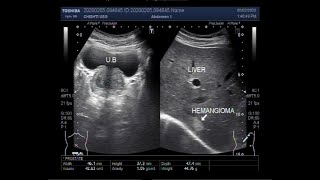 Ultrasound Video showing Hemangioma in Liver [upl. by Naired]