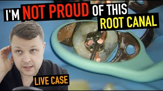 MANAGEMENT OF CALCIFIED CANALS  LIVE 4K ROOT CANAL [upl. by Aneeled]