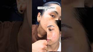 2 weeks using differin gel foryou shortvideo ytshorts hormonalacne acne acnejourney differin [upl. by Anavi]