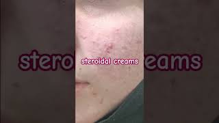 Whitening Cream Side Effects l Red Face [upl. by Milano283]