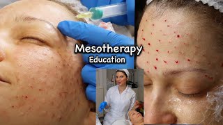 Mesotherapy for Face including around the Eyes injection technique using 13mm 30G needle [upl. by Pals]