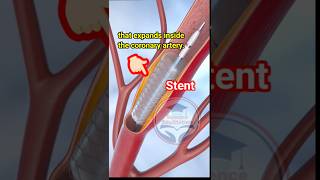 Angioplasty🫀❤️‍🔥 Stent Insertion in Blood vessels science medical angioplasty shorts viral [upl. by Kcirdes]