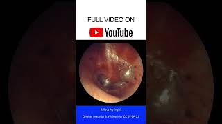 Bullous Myringitis Otoscopy [upl. by Ehc]