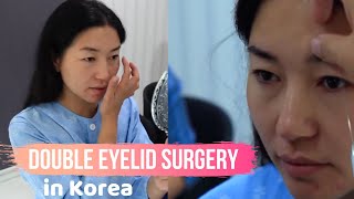 Incisional Double Eyelid Surgery in Korea [upl. by Oninotna]