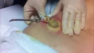 AMAZING CYST REMOVAL VERY SATISFYING [upl. by Rysler]