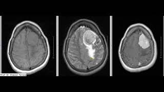 MENINGIOMA MRI BRAIN [upl. by Yema235]