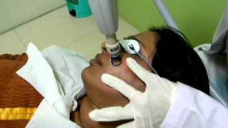 Fractional Erbium YAG Laser Treatment for Acne Scars  Dr Rinky Kapoor [upl. by Bancroft]