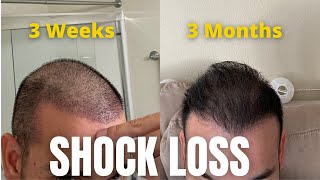 When Do Hair Transplants Start To Grow Prepare Yourself Mentally For Surgery [upl. by Onfre878]