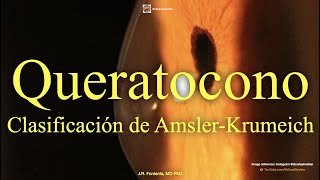 Queratocono Clasificación de AmslerKrumeich [upl. by Nwahc523]