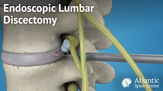 Endoscopic Lumbar Discectomy [upl. by Jarl228]