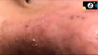 new blackhead whitehead extraction 2019 340 [upl. by Claud]