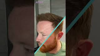 Hairline Restoration with FUE Hair Transplant  Longevita [upl. by Rebba]