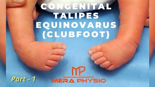 Congenital Talipes Equinovarus Clubfoot  part 1  Introduction  In Hindi  Mera Physio [upl. by Graehl]