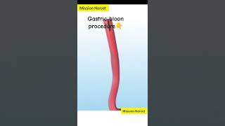 gastric balloon procedure in3d animationgastric problem solutionshorts trending [upl. by Montanez]