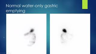 Nuclear medicine GI Scintigraphy [upl. by Swanson]