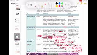 Adenocarcinoma Respiratory 54  First Aid USMLE Step 1 in UrduHindi [upl. by Lara55]