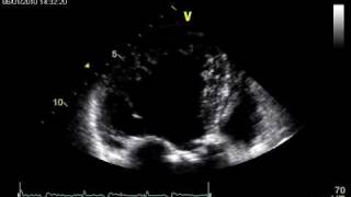 NON COMPACTION CARDIOMYOPATHY [upl. by Shugart]