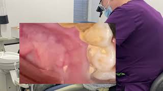 Remove tartar dental cleaning duet scaling teeth [upl. by Sucramat724]