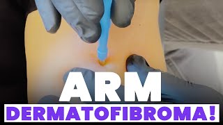 ARM DERMATOFIBROMA [upl. by Emmalynne]