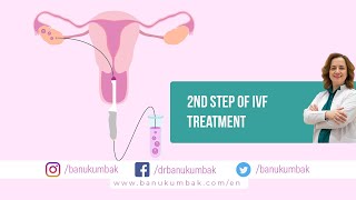 2nd Step of IVF Treatment Oocyte PickUp OPUBanu Kumbak Aygün MD Professor [upl. by Nanon]