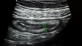 Terminal ileitis ultrasound case [upl. by Amahcen492]