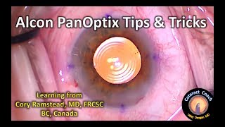 Alcon PanOptix Trifocal IOL Tips amp Tricks for Cataract Surgery [upl. by Gnav197]