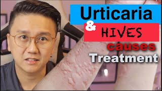 URTICARIA amp HIVES  Causes and Treatment of Itchy Skin Rash [upl. by Nawram]