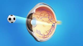 Cataract Surgery with a Multifocal Lens [upl. by Hsima523]