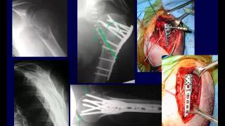 Proximal Humerus Fractures 2 OTA lecture series III u03b [upl. by Nakre917]