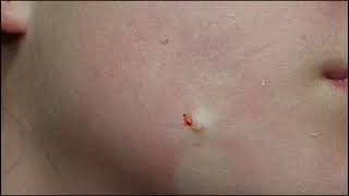 332 Molluscum Contagiosum Removal on Teenager Jawline Part 2 [upl. by Reifinnej]